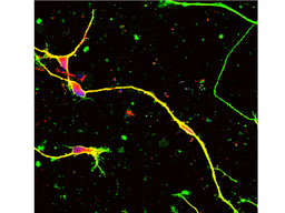 A new genome editing method by gene therapy could be a radical therapy for Charcot-Marie-Tooth disease type 1A due to duplication of 1.5 mega base genome region