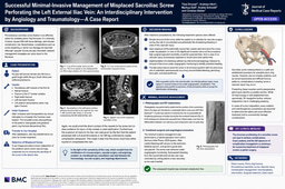 When a Sacroiliac Screw Becomes a Vascular Emergency: An Interdisciplinary, Minimally Invasive Solution to External Iliac Vein Perforation