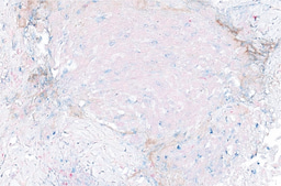 Transcriptome analysis reveals key information about a rare pediatric cancer and response to immune checkpoint inhibitor monotherapy
