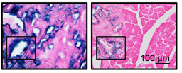 Senolytic Therapy of PDAC