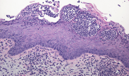 Cause or consequence? How an “inert control protein” fuels the fire of pathologic inflammation in response to Candida albicans