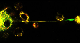 When leukemia cells bring macrophages over their side 