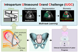 Jieyun Bai's Paper "Maternal-Fetal Ultrasound Video Dataset for End-to-End Intrapartum Biometry and Multi-task Learning "