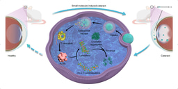 mRNA therapy reverses cataract