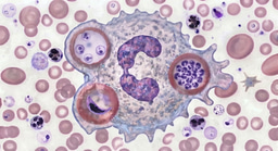 When a Blood Smear Tells the Story: Diagnosing Fatal secondary hemophagocytic lymphohistiocytosis in Pregnancy