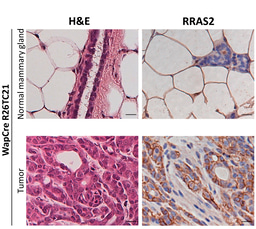 Unmutated RRAS2 Emerges as a Key Oncogene in Post-partum-associated Triple Negative Breast Cancer