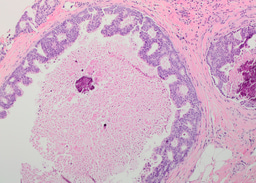 Pathological features of 11337 patients with primary ductal carcinoma in situ (DCIS) and subsequent events – results from the UK Sloane project