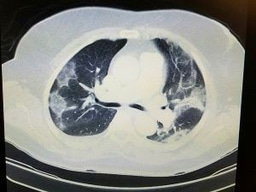 Call for papers: Connective tissue disease-associated interstitial lung disease