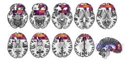 Looking beyond averages: Our study of lifestyle, depression, and brain ageing
