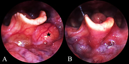 Behind the Paper: Revolutionizing Epiglottic Cyst Treatment with Videolaryngoscope-Assisted Coblation