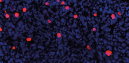 From chemotherapy resistance to immune escape: the evolving story of NCOR2