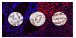 Leveraging very-long-chain fatty acids for diagnostics and strategies for taming chemoresistance in colorectal cancer