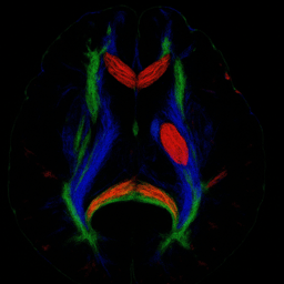 TSR Exchange — MCC950 in Aging Stroke