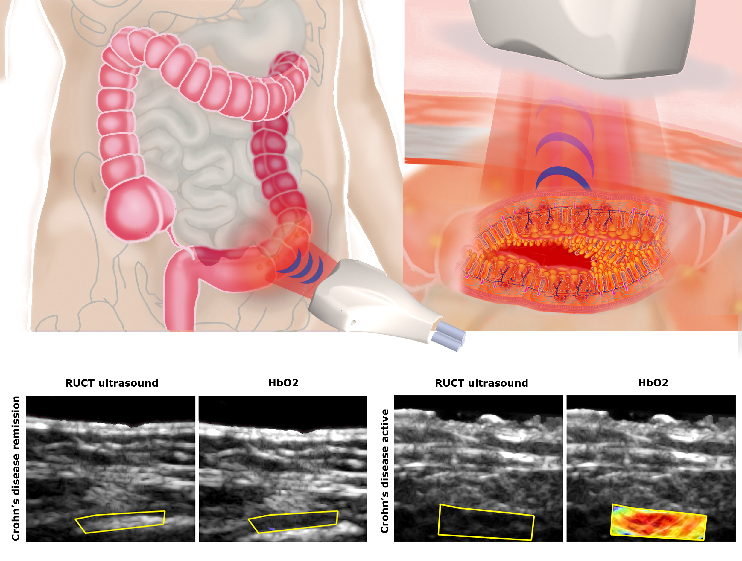 Modified Riley Score Non-invasive diagnostic imaging in Crohn’s disease | Research ...