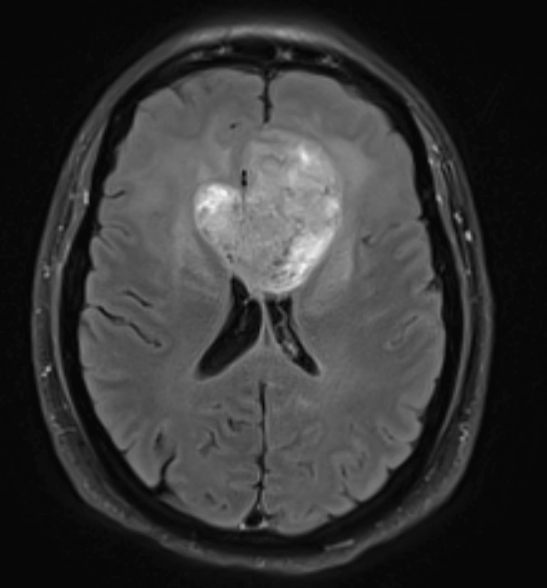 Time matters when moving and growing fast: predicting glioblastoma prognosis and clinical outcome in a patient-specific manner
