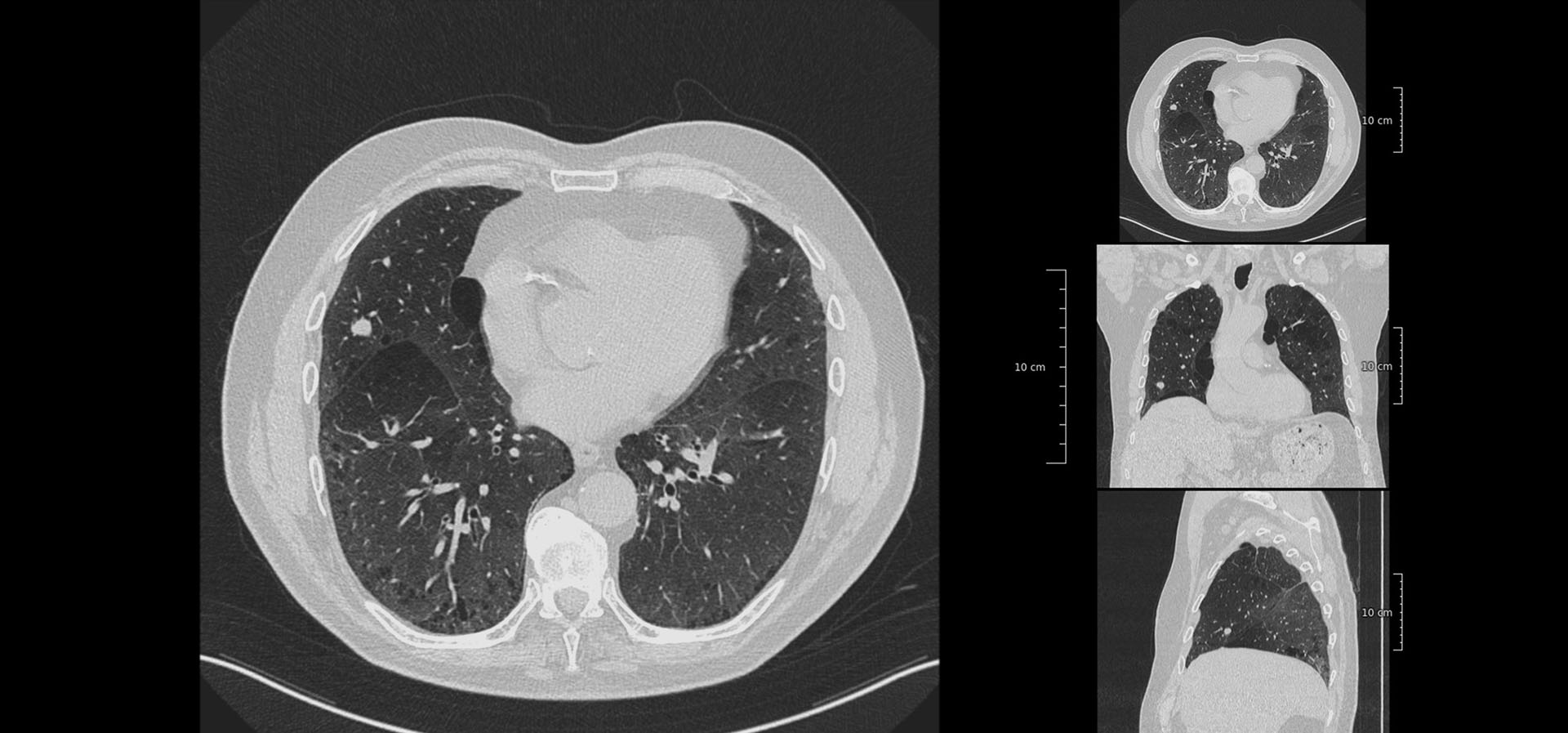 Deep learning for the detection of benign and malignant pulmonary nodules in non-screening chest CT scans