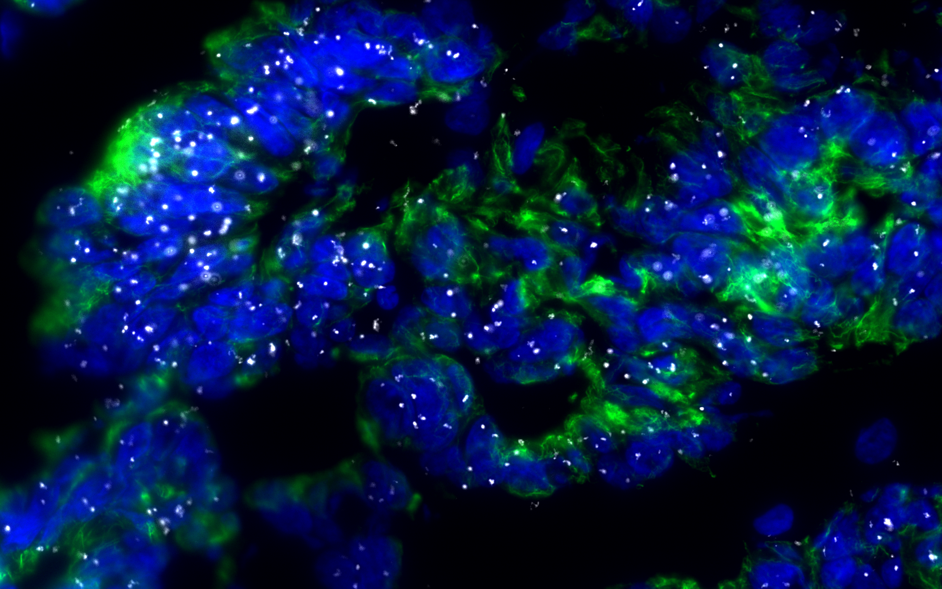 Amyloid-like p53 is a prognostic marker in serous ovarian cancer