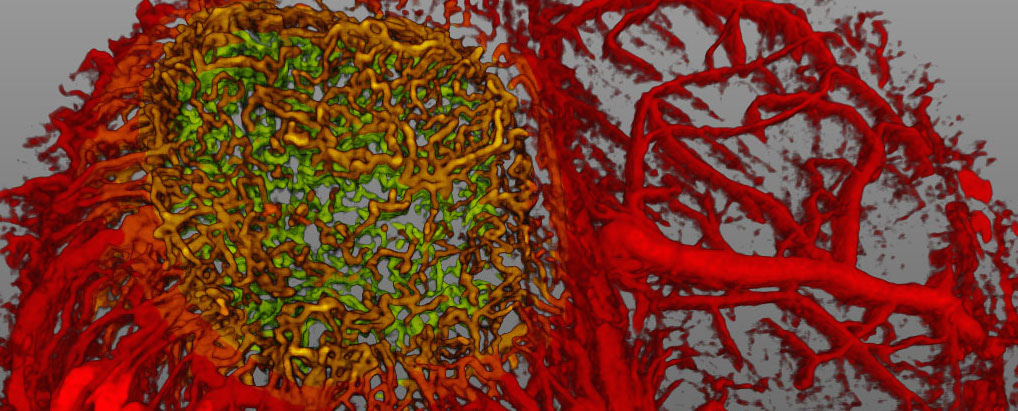 Brain tumor-generated solid stress impairs vessel perfusion and neurological function