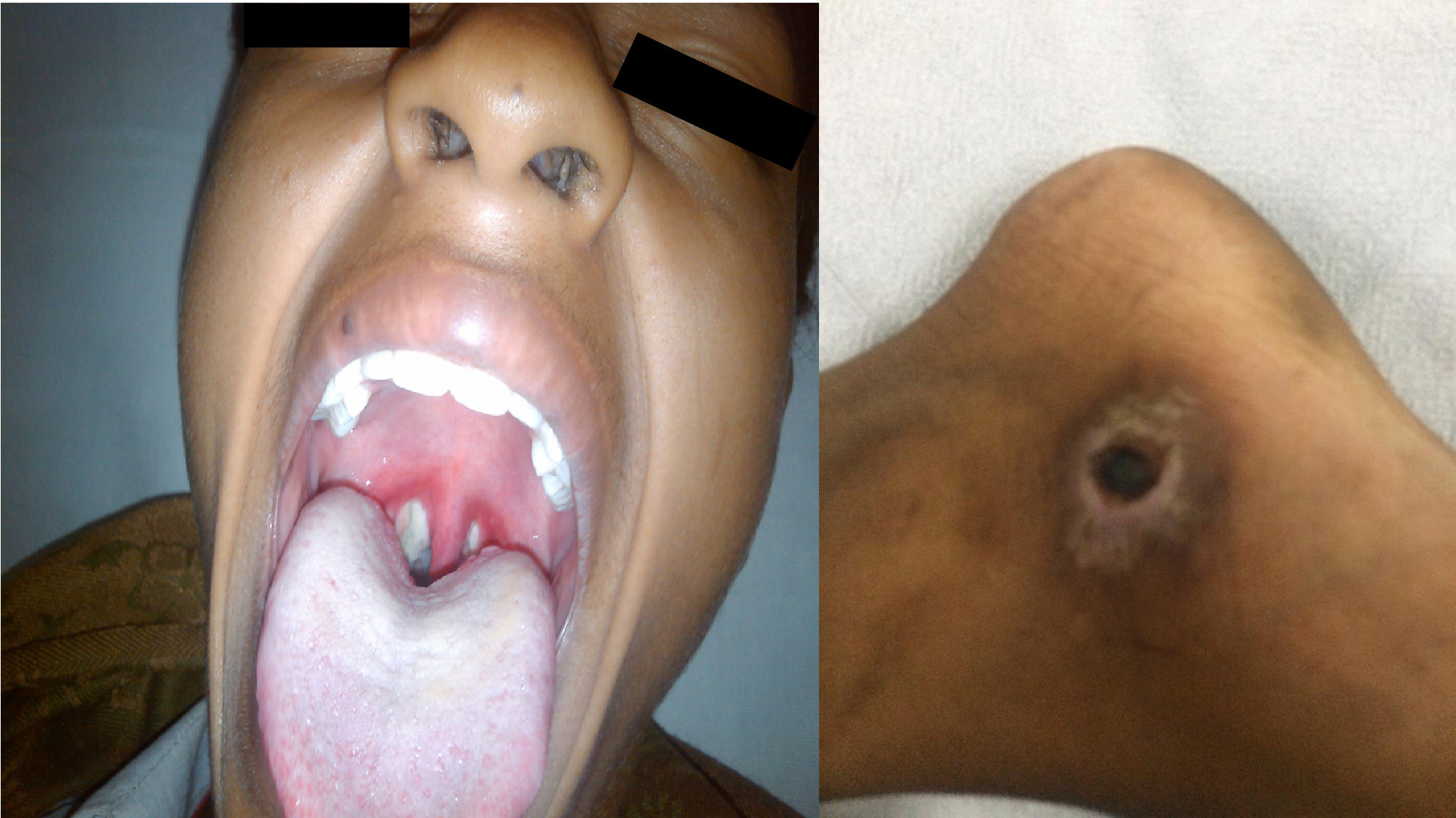 Diphtheria: A re-emerging major global threat