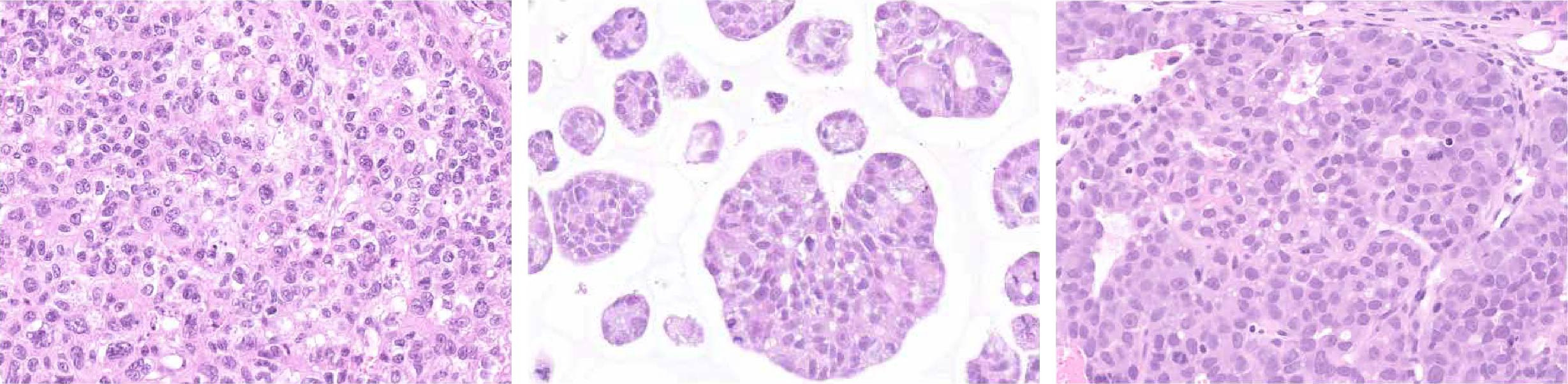 Patient-derived tumor organoids for personalized medicine in liver cancer