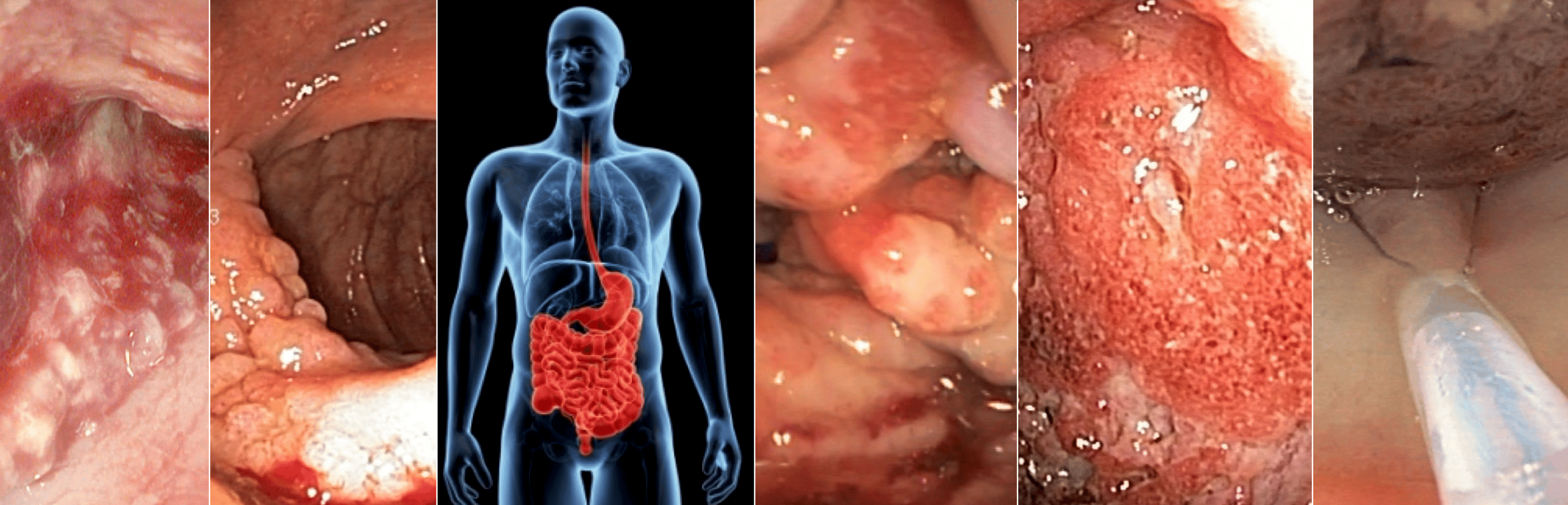 HyperKvasir: Data to enable AI for automated GI disease detection