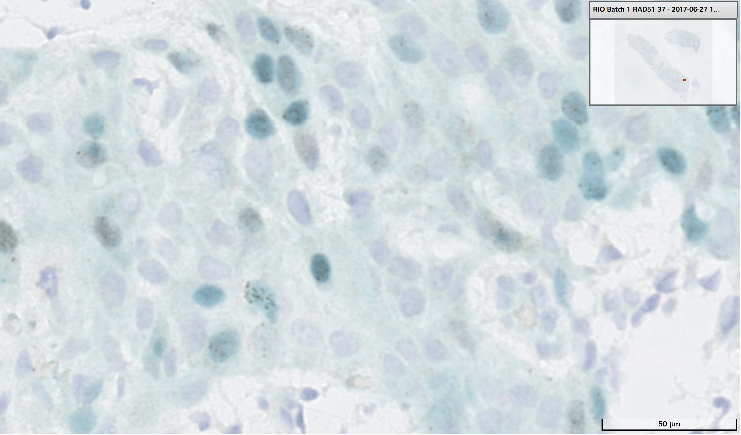 Homologous recombination DNA repair deficiency and PARP inhibition activity in primary triple negative breast cancer