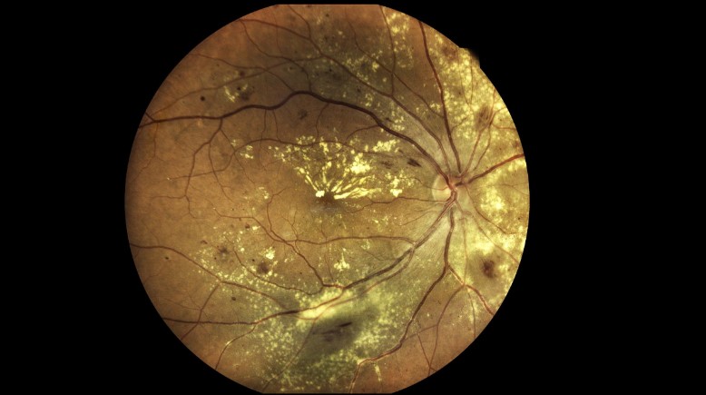 Macular degeneration Collection - Contribution Highlights