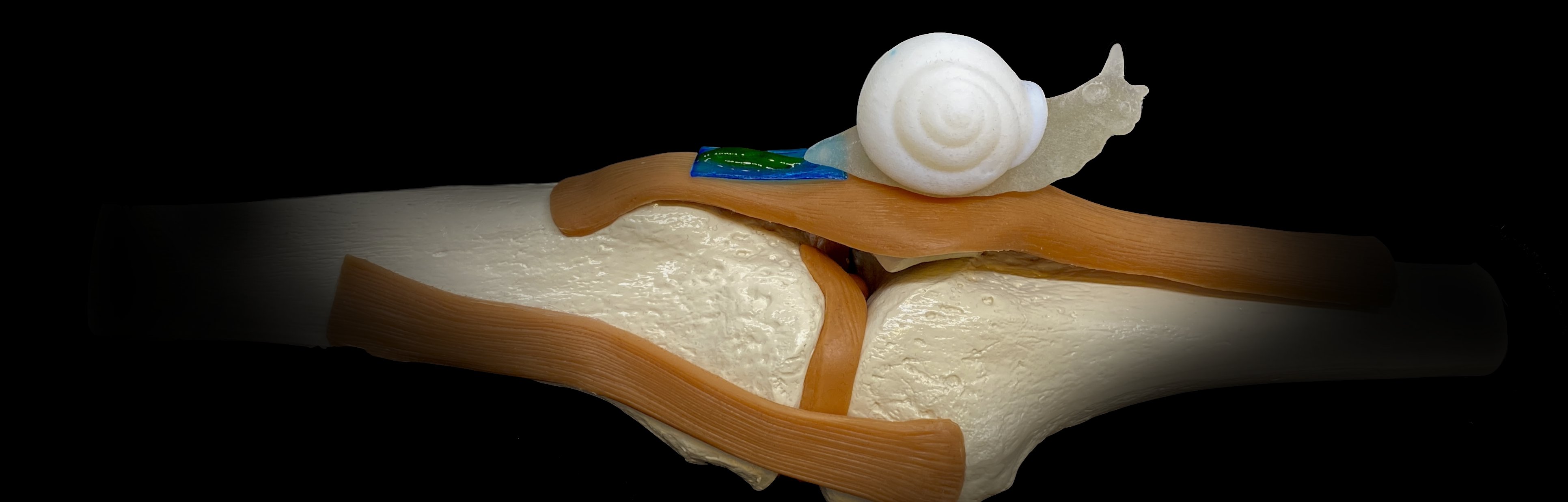 A drug delivering hydrogel adhesive with two faces
