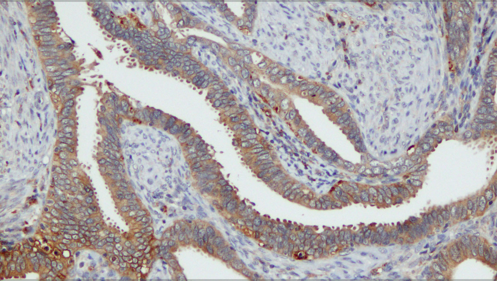A 10-gene prognostic signature points to LIMCH1 and HLA-DQB1 as important players in aggressive cervical cancer disease