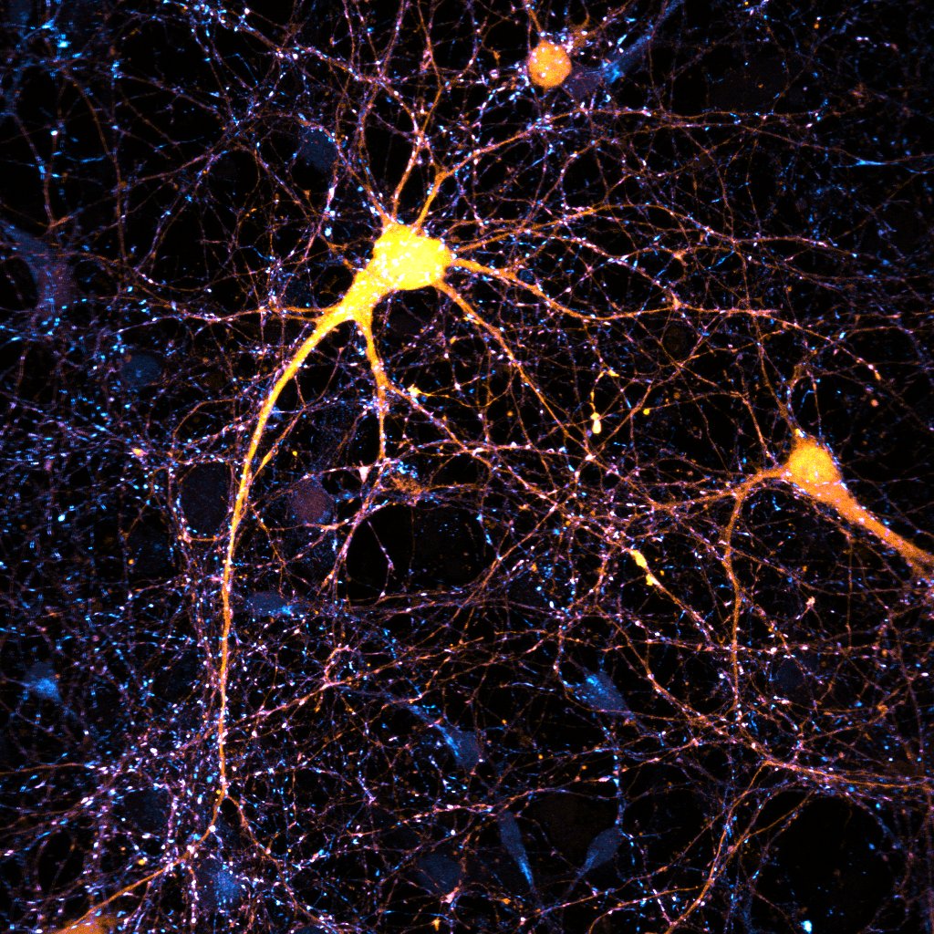 DOPAL initiates αSynuclein-dependent impaired proteostasis and degeneration of neuronal projections in Parkinson’s disease