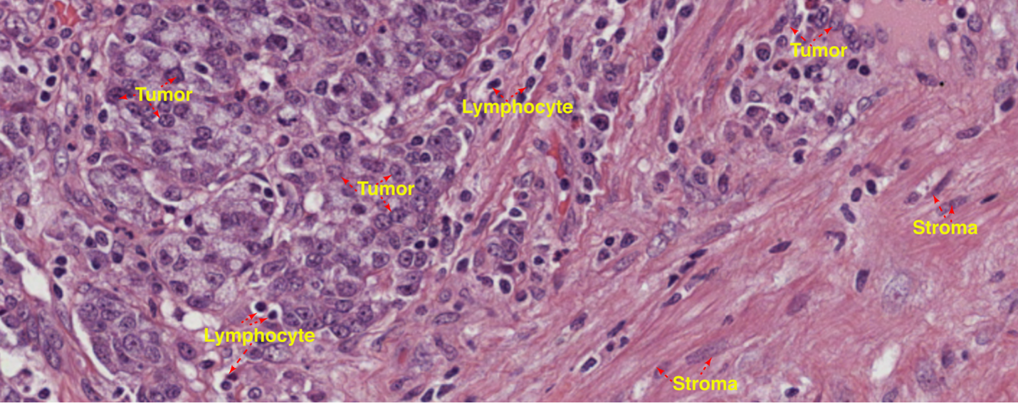 Tumor-specific total mRNA expression: a robust and prognostic feature across cancers