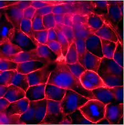The influence of mechano-active ion channels during kidney stone formation
