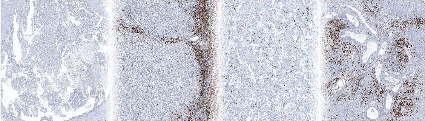 From patients to tumor avatars: A journey towards personalized immunotherapy research