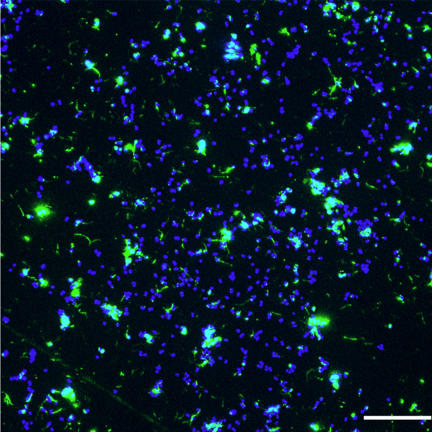 How MDA Phages Select Hyperadhesive Variants in Neisseria meningitidis?