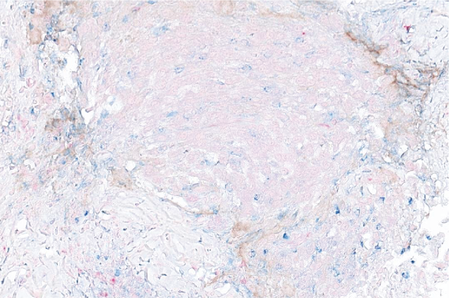 Transcriptome analysis reveals key information about a rare pediatric cancer and response to immune checkpoint inhibitor monotherapy