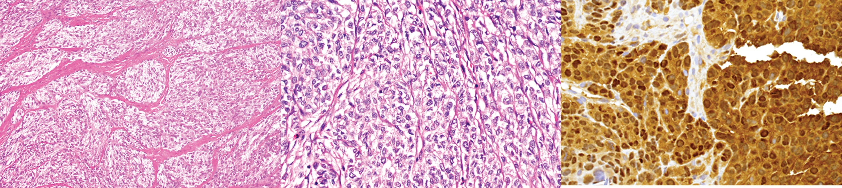 Functional Genomics of Human Clear Cell Sarcoma