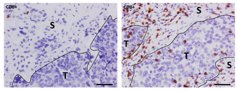 IMMUNOTHERAPY AS A POTENTIAL THERAPEUTIC OPTION IN THE MANAGEMENT OF EPITHELIAL OVARIAN CANCER