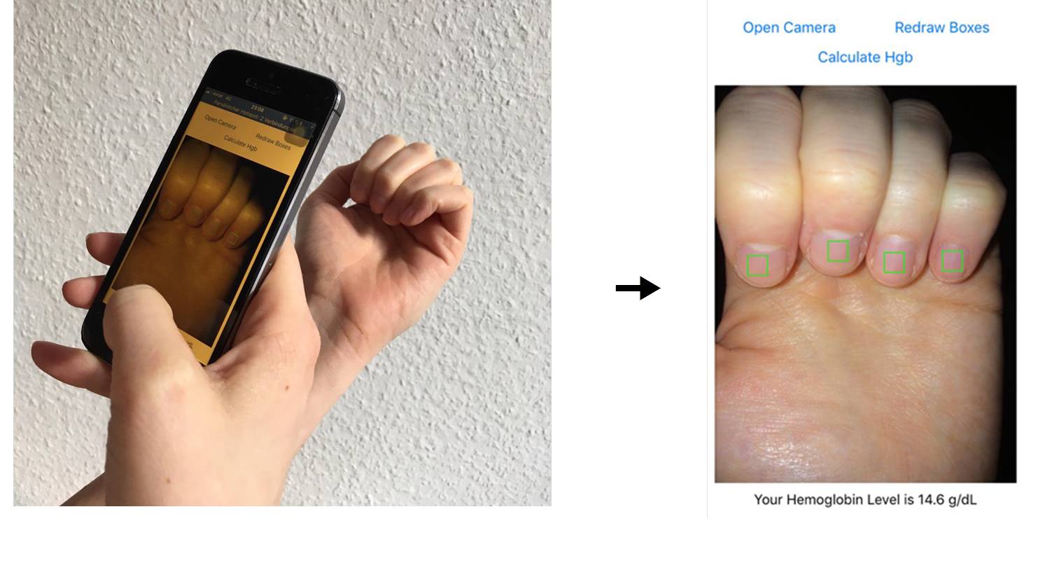 Measuring hemoglobin levels by taking pictures of fingernail beds with a smartphone