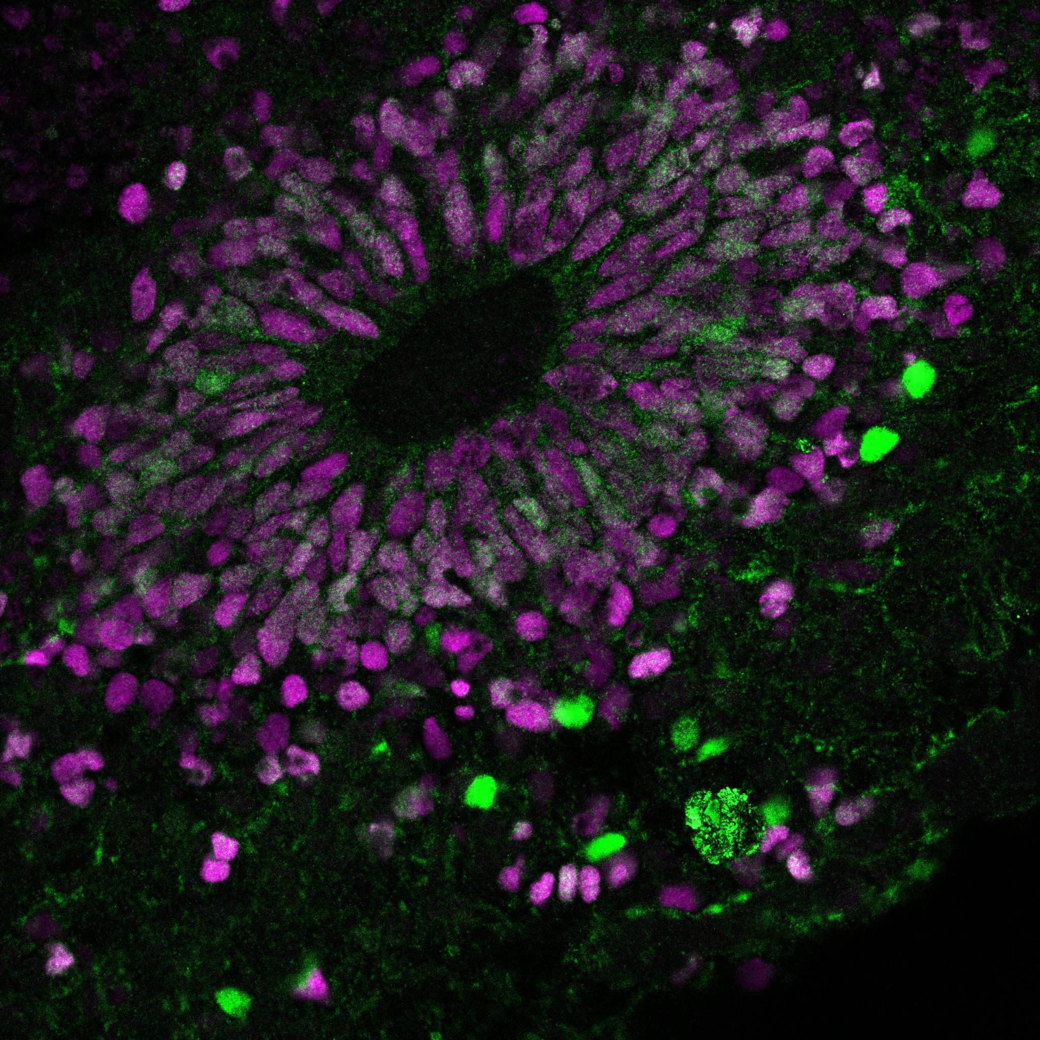 Human brain organoid model of maternal immune activation identifies radial glia cells as most vulnerable