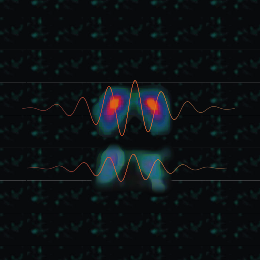 Relative sparing of dopaminergic terminals in the caudate nucleus is a feature of rest tremor in Parkinson’s disease
