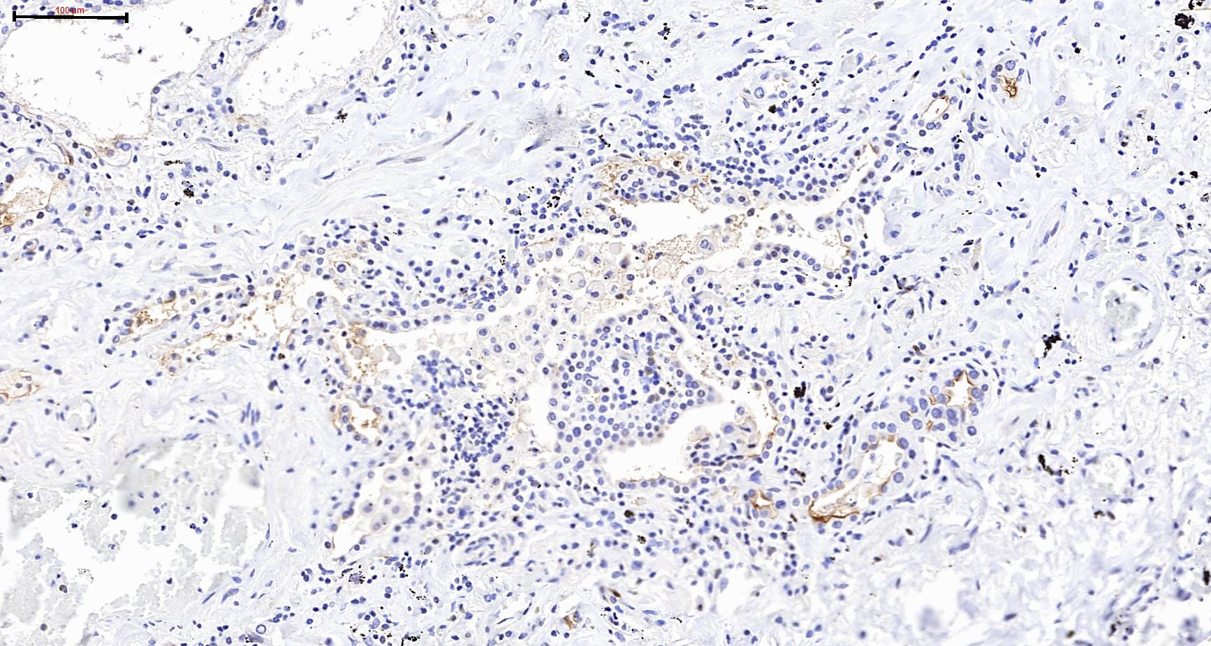 Chronic lung disease and SARS-CoV-2
