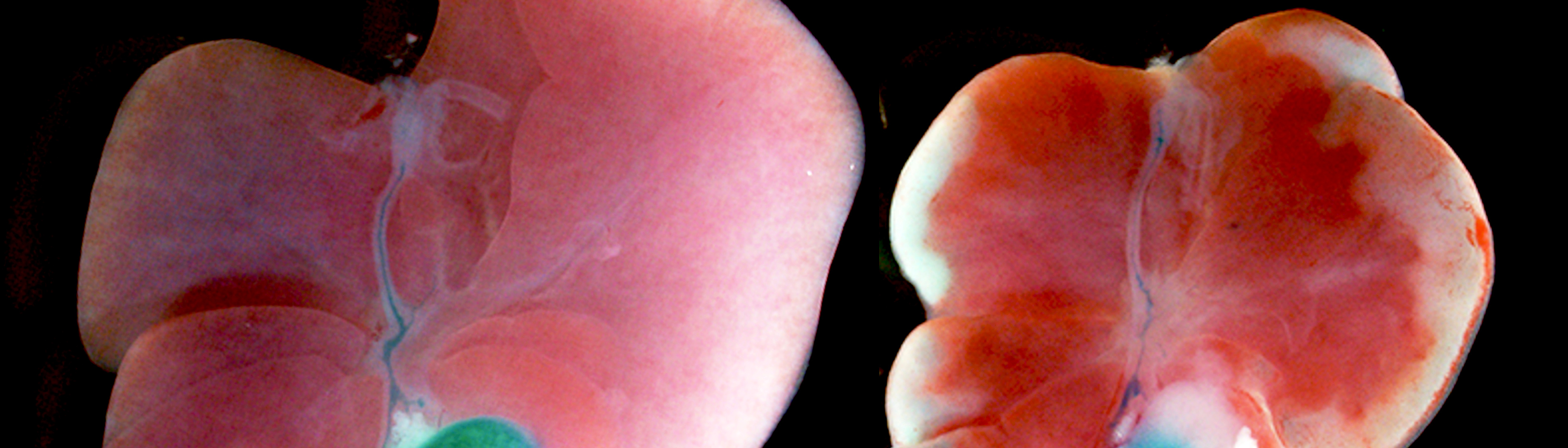 Impact of Gallbladder Hypoplasia on Hilar Hepatic Ducts in Biliary Atresia