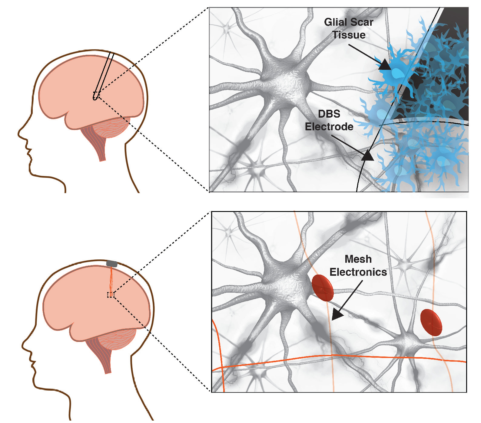Precision electronic medicine in the brain