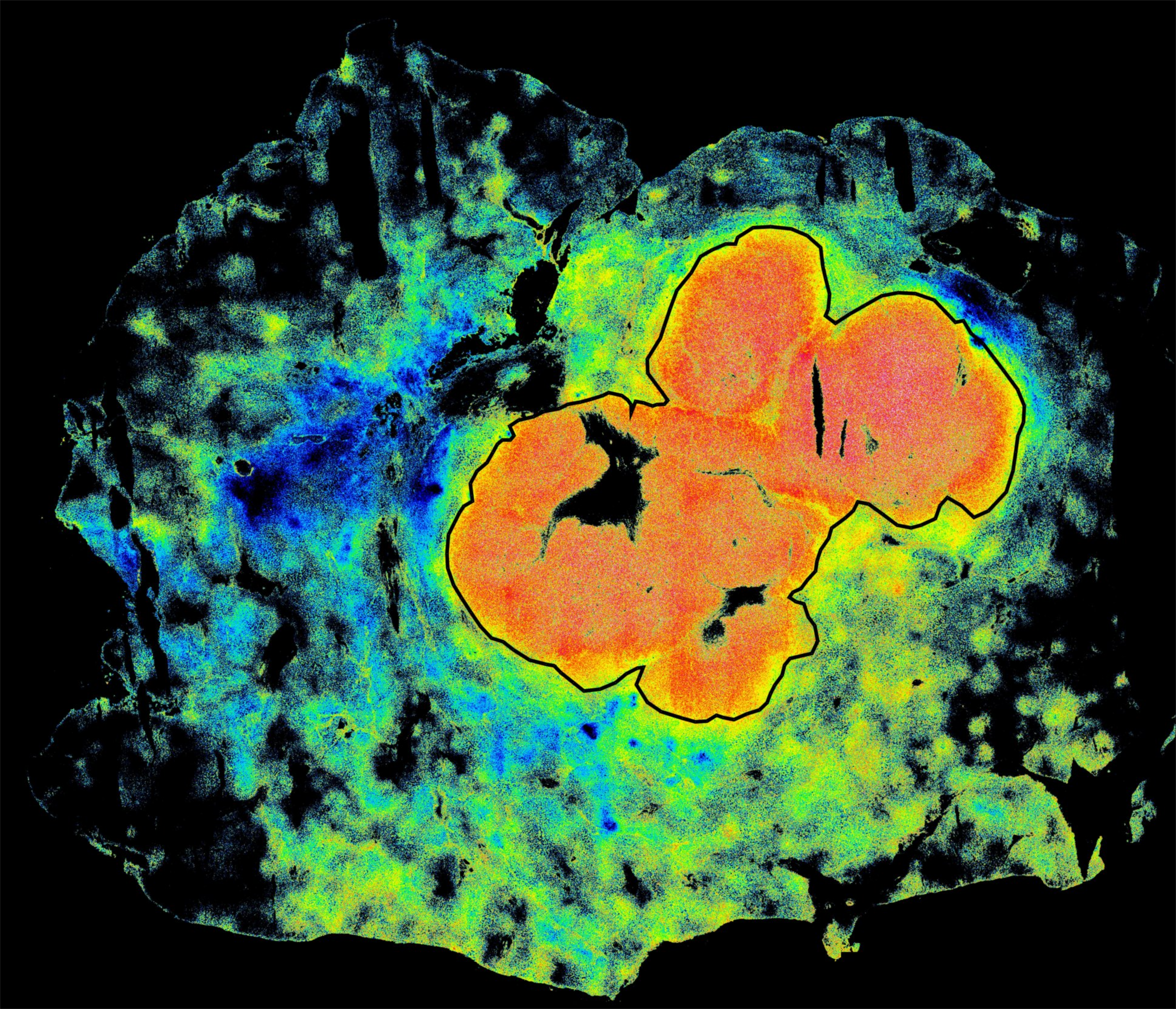 Enhanced tumor visualization in patients using fluorescence lifetime imaging and indocyanine green