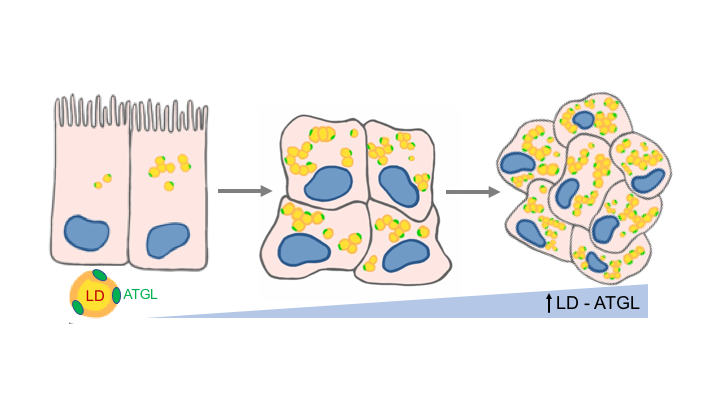 Elevated ATGL in colon cancer cells and cancer stem cells promotes metabolic and tumorigenic reprogramming reinforced by obesity  