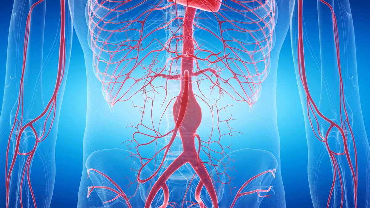 Continue exploring - Aortic aneurysm and dissection management Collection