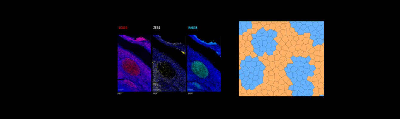 How do melanoma cells decide their fate? A mathematical view of cell state dynamics