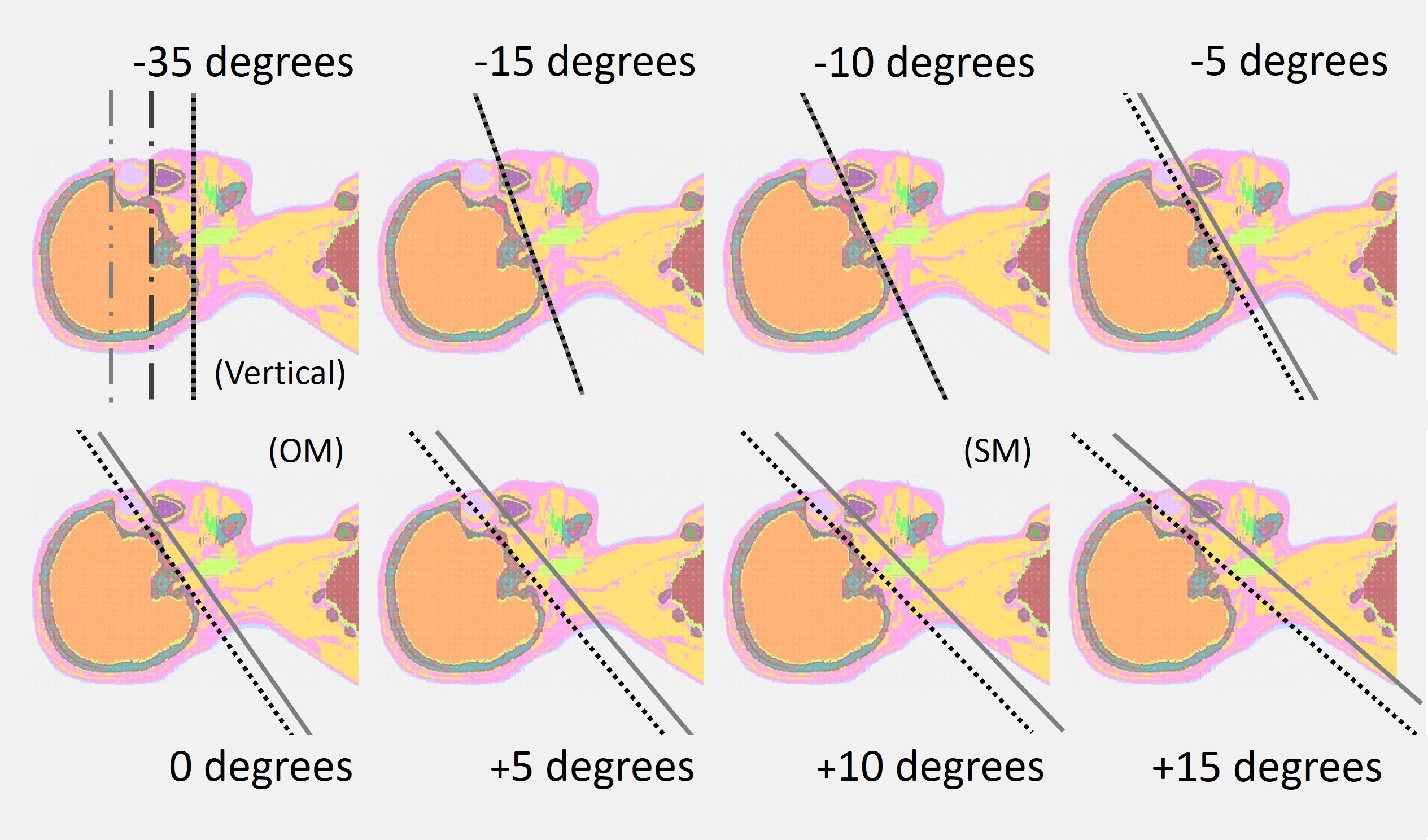 Why Gantry Tilt Alone Is Not Enough in Head CT: Visualizing Eye Lens Dose Distribution with Monte Carlo Simulation