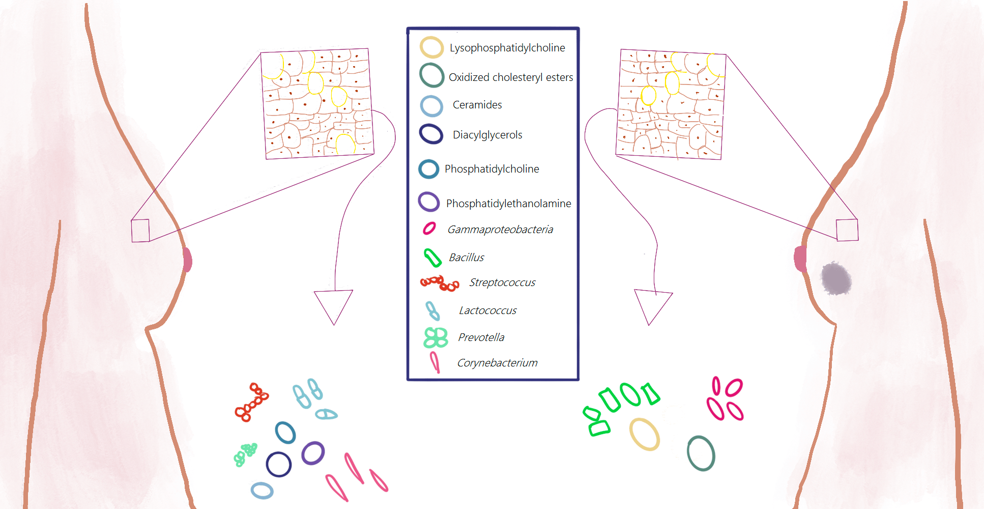 Microbes and lipids: new insights into the breast cancer puzzle