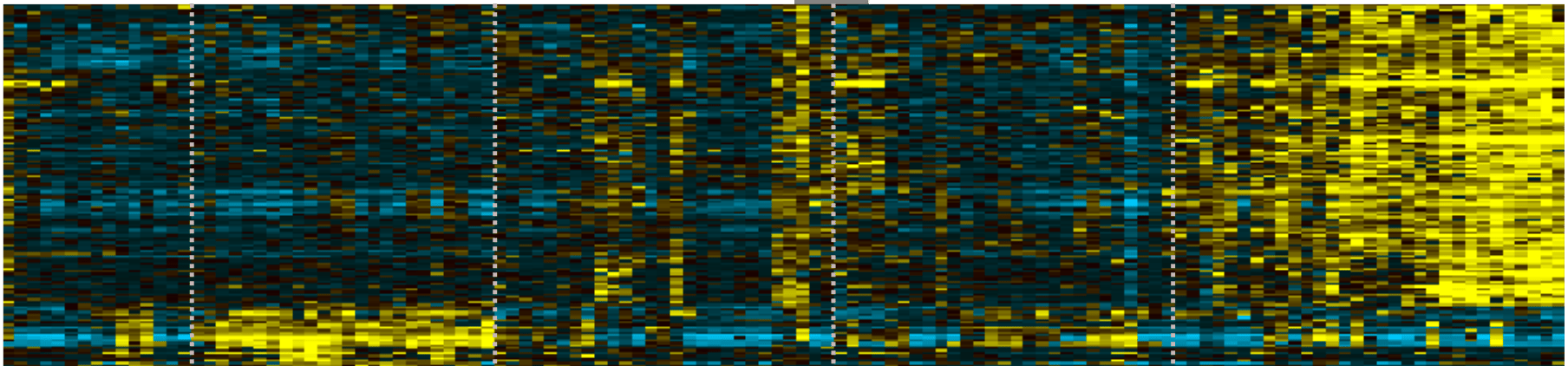 A transcriptomic continuum of differentiation arrest identifies myeloid interface acute leukemias with poor prognosis 